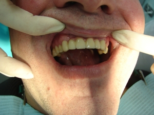 Лазерная имплантация зубов в Киев