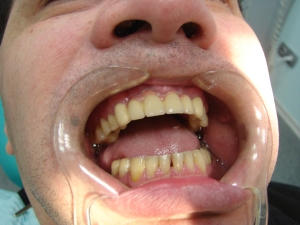 Лазерная имплантация зубов Киев
