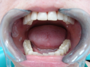 Протезирование зубов в киеве